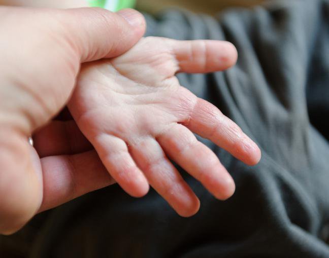 6. Zapalenie skóryNiekiedy skóra dziecka reaguje po dotykaniu jedzenia, mydła lub roślin takich jak dąb czy bluszcz. Wysypka pojawia się około 48 godzin po kontakcie czynnika wywołującego ze skórą. W łagodnych przypadkach jest to zaczerwienienie lub wysypka z małych czerwonych krostek. W poważniejszych pojawia się opuchlizna i większe pęcherzyki. Zapalenie skóry przechodzi po 1-2 tygodniach.