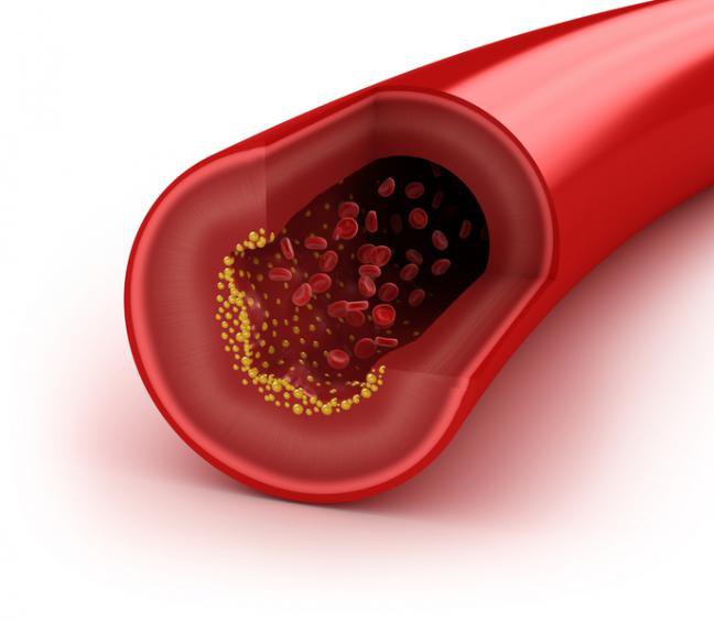 6. CholesterolWysoki poziom cholesterolu może doprowadzić do zatoru żył. Ten proces może następować bardzo powoli, nie dając widocznych symptomów, ostatecznie skutkując zawałem serca bądź też wylewem. Do miażdżycy może prowadzić również wysokie ciśnienie krwi, palenie papierosów czy cukrzyca. Zmiana stylu życia, jak i lekarstwa mogą zmniejszyć ryzyko. Aby sprawdzić swój cholesterol, musisz zastosować 12-godzinną głodówkę. Następnie wykonany zostaje test krwi, który mierzy zarówno tak zwany zły i dobry, jak i całkowity cholesterol. Jeśli masz skończone 20 lat, taki test powinieneś przeprowadzać co pięć lat.
